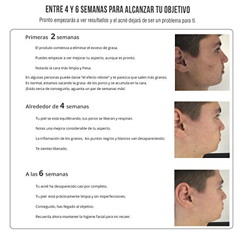 ZOWIX Antiacne en Espuma Limpiadora. Foam purificante suave contra el acne facial. Limpia, desintoxica y ayuda a eliminar espinillas, puntos negros y granos. 150 ml.