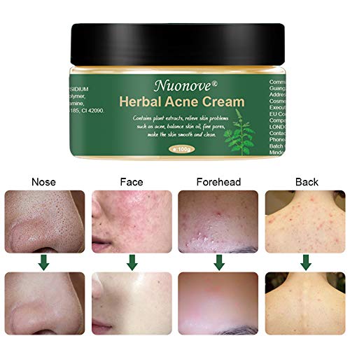 Crema Antiacne, Acné Crema, Anti Acne, Acne Tratamiento, Acne Cream, Reducir los Puntos negros, Equilibrar el Agua y el Aceite, la Crema Contra el Acné Espinilla, Regenera la piel, 100 g