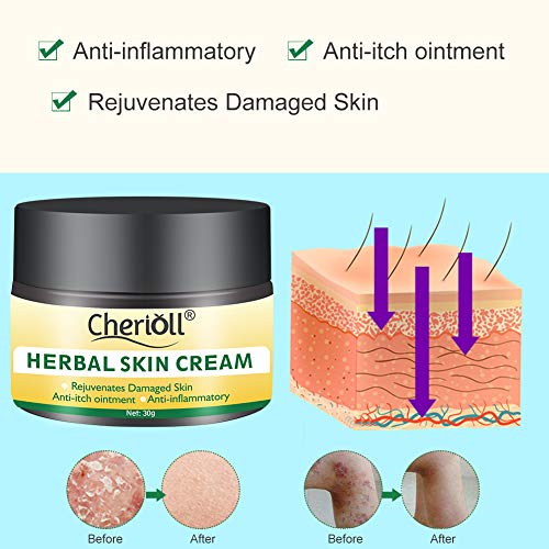 Crema para el cuerpo, tratamiento para la psoriasis, eccema, rosácea y dermatitis, la crema herbal china natural reduce la sequedad y la inflamación