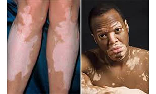 Vitiligo Cura