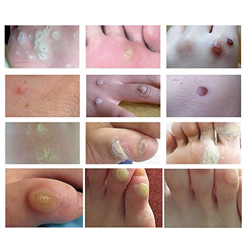 Wart Remover, Verrugas, Tratamiento Anti Verrugas Tratamiento para Quitar Verrugas Comunes y Plantares, Congela las Verrugas de Raíz, Wart Remover para Pies y Manos