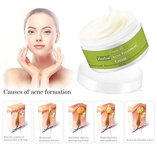 Crema Antiacne, Acné Crema, Acne Tratamiento, Anti Acne, Acné Suavemente Suficiente Para Pieles Sensibles, Hombres, Mujeres – Ayuda a Eliminar el Equilibrar Cara Agua y Aceite, Acné Fosos de Reparar