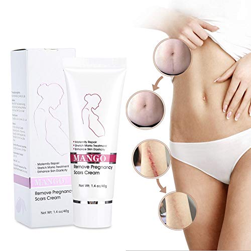 Anti-estrías posparto para diluir las estrías, reparar la crema corporal hidratante abdominal, líneas de grasa, eliminar las líneas de obesidad para reforzar los productos de prevención para