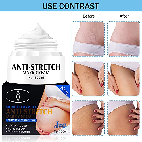 Crema para Estrías, Crema Antiestrias Embarazo, Anti-estrías Posparto Para Diluir Las Estrías, Reparar La Crema Corporal Hidratante Abdominal