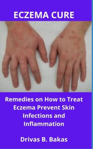 ECZEMA CURE: Remedies on How to Treat Eczema, Prevent Skin Infections and Inflammation