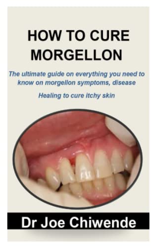 HOW TO CURE MORGELLON: The ultimate guide on everything you need to know on morgellon symptoms, disease healing to cure itchy skin