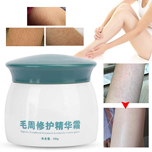 Crema de queratosis Pilaris Tratamiento calmante para el cuerpo Crema KP Crema para el cuidado del cuerpo para pieles ásperas y rugosas, 50 g / 1.8 oz