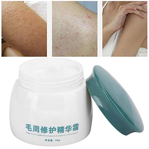 Crema de queratosis Pilaris Tratamiento calmante para el cuerpo Crema KP Crema para el cuidado del cuerpo para pieles ásperas y rugosas, 50 g / 1.8 oz