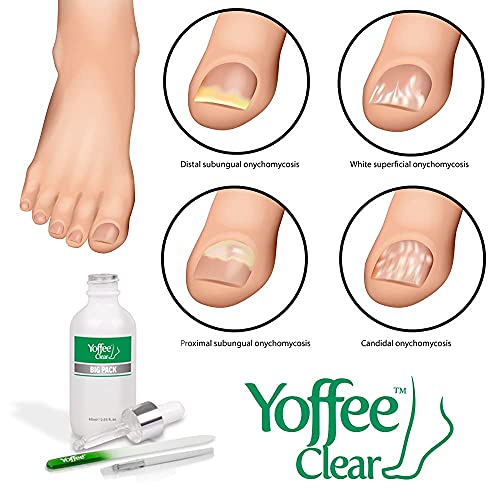 Yoffee Clear Kit Big Pack - Purity Nail - Tratamiento Anti Hongos para Uñas de Manos y Pies - con Árbol de Té y Aceite de Argán - Fórmula Mejorada - Antibacteriano y Antiséptico - Nuevo Formato (60ml)