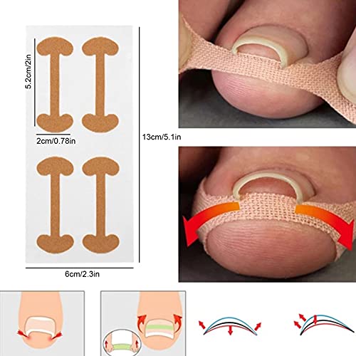 Corrector de Uñas de Los Pies,Parche de Corrección de Uñas de los Pies,Pegatinas de Uñas Encarnadas Corrección Pegatina Cuidado De Los Pies de Las Sin Pegamento para Hombres Mujeres 10PCS