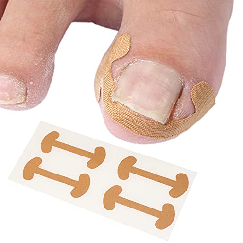 Corrector de Uñas de Los Pies,Parche de Corrección de Uñas de los Pies,Pegatinas de Uñas Encarnadas Corrección Pegatina Cuidado De Los Pies de Las Sin Pegamento para Hombres Mujeres 10PCS