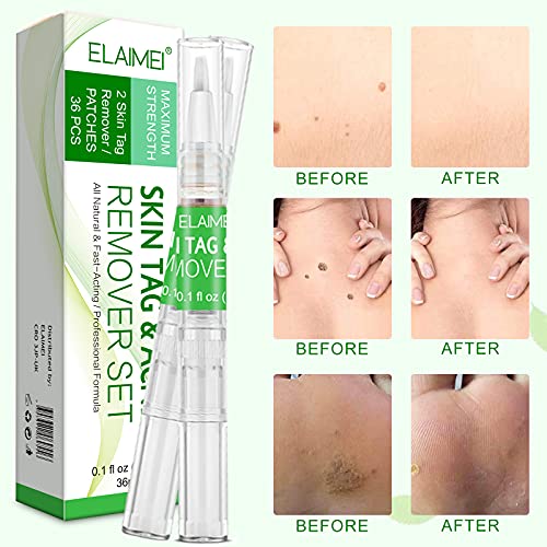 Skin Tag Remover, Pluma Líquida para Eliminar Verrugas, Skin Tag Remover Patch, Mole Removal, Remover Verrugas Eliminar, para la Cara, el Cuerpo (2 Bolígrafos, 36 Piezas)