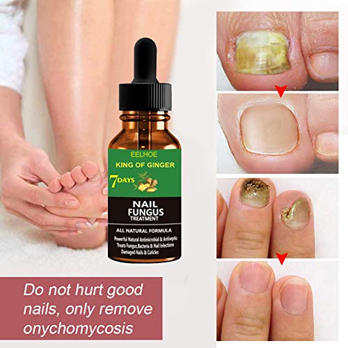 Tratamiento De UñAs,Nail Mycosis Solution,Nails Tratamiento Anti Hongos Y Blanqueador Para UñAs,Hongo UñAs Tratamiento,ReparacióN De UñAs,Tratamiento Contra Hongos E Infecciones De Las UñAs