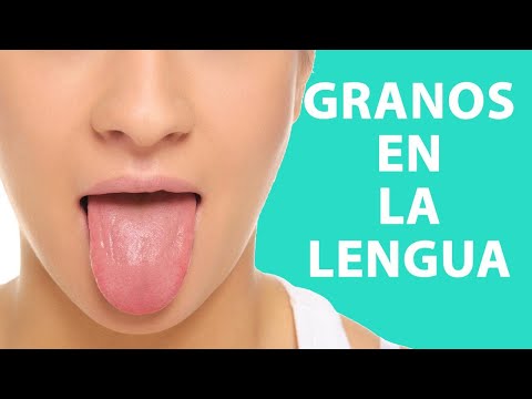 Por qué aparecen los granos en la lengua y cómo tratarlos
