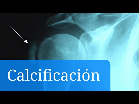 La calcificación en los huesos: qué es y cómo afecta a nuestra salud