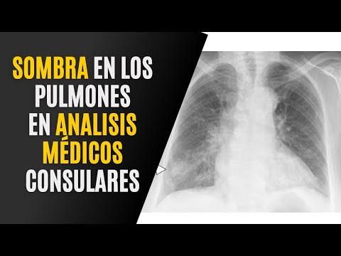 Qué significan las manchas en el pulmón: una guía informativa
