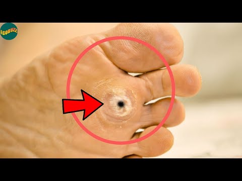 Cómo eliminar los ojos de gallo en los pies de forma efectiva