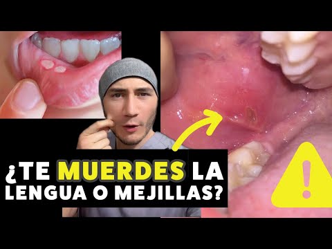 Consejos para aliviar el dolor después de morderse la lengua