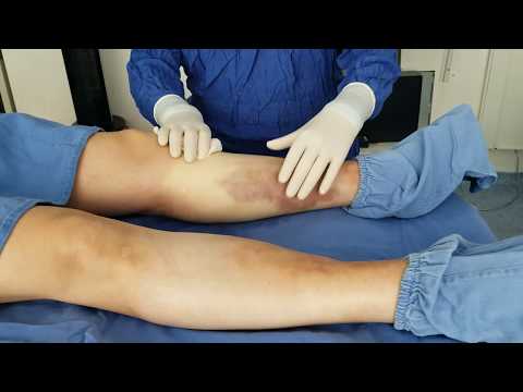 Cómo tratar las manchas negras en el talón del pie