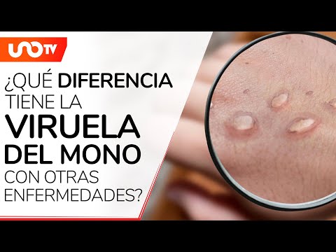 Las diferencias entre viruela y varicela: ¿Dos enfermedades distintas?