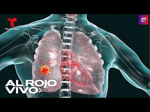 Posibles implicaciones de una mancha en el pulmón: lo que debes saber en 2024.